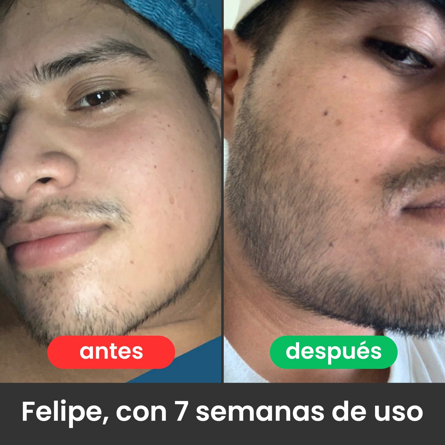 LLEVA 2X POR SUPER PRECIO Bálsamo para Crecimiento de Barba Ultra Potente con Minoxidil 20% | 100mL